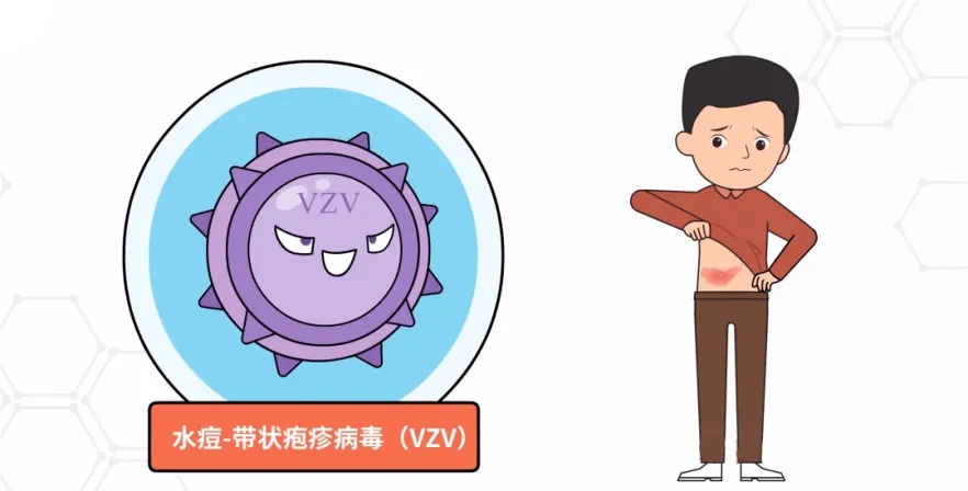 带状疱疹