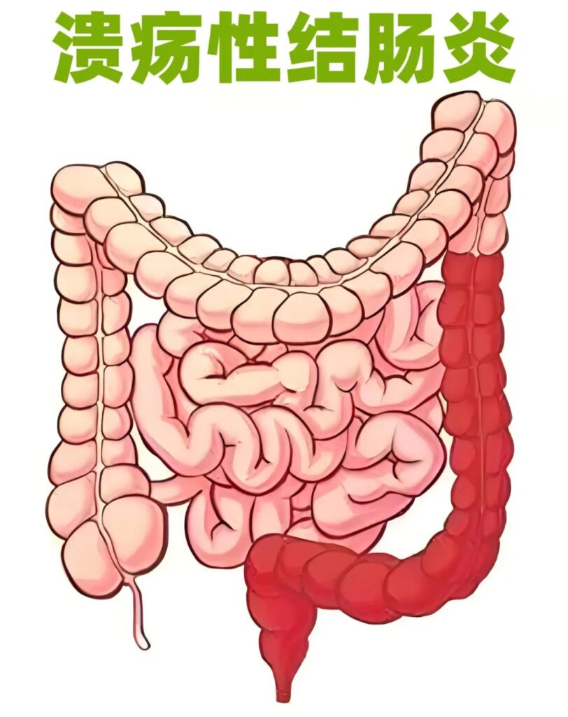 溃疡性结肠炎