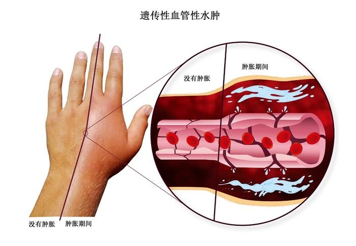 遗传性血管性水肿(HAE)