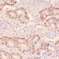 小鼠乳腺癌组化